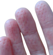 Temporary pressure marks on fingertips after using Kaiko SpiKEYring for safe ouch sensory input