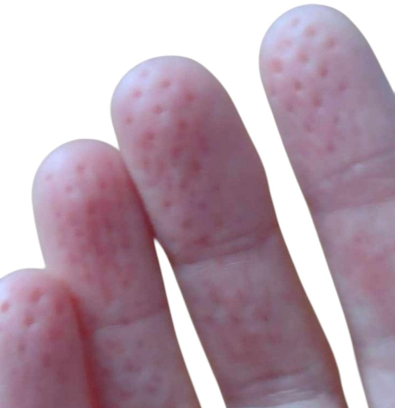 Temporary pressure marks on fingertips after using Kaiko SpiKEYring for safe ouch sensory input